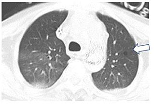Electrical impedance tomography to aid in the identification of hypoxemia etiology: Massive atelectasis or pneumothorax? A case report